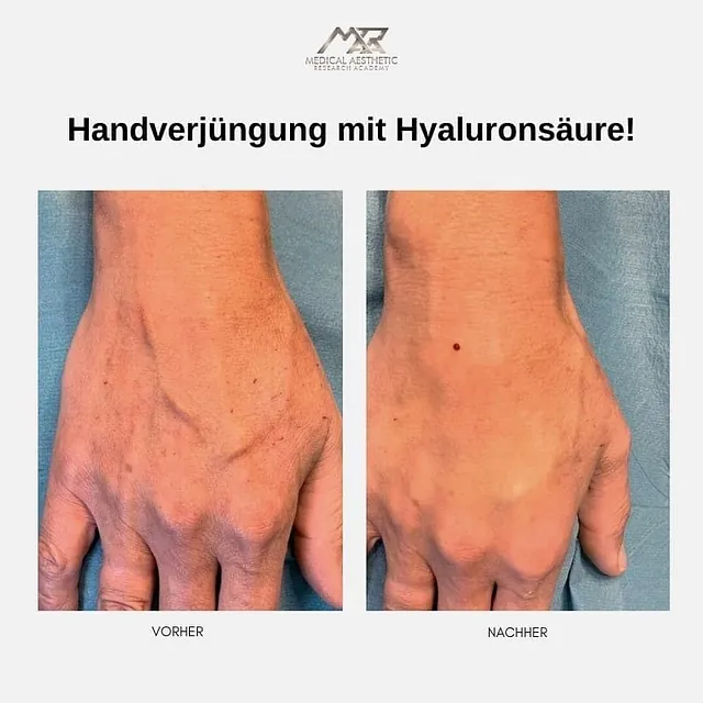 Handverjüngung mit Hyaluronsäure